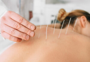 acupuncture & acupressure for back pain relief